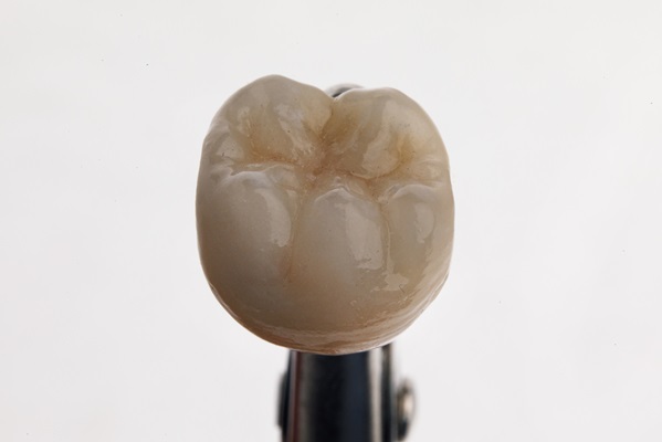 What Materials Are Used To Make Dental Crowns?